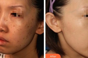 上海伊美爾港華醫(yī)療美容醫(yī)院杜志蘋整形價格表附激光調(diào)節(jié)曬斑案例展示