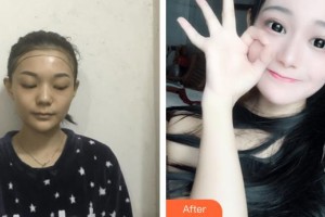 上海瑞陽整形外科門診部孫永剛整形價格表附種植發(fā)際線案例展示