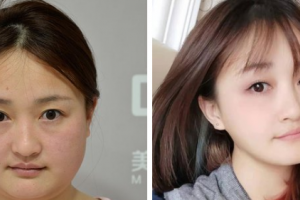 南京雨花城南口腔醫(yī)院羅敏整形價(jià)格表附種植牙案例展示