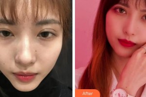 上海美之源整形外科醫(yī)院崔爽整形價(jià)格表附超激光美膚嫩膚多方面部案例展示