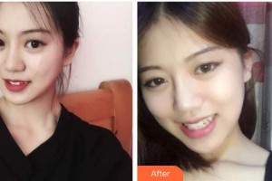 上海申德醫(yī)院醫(yī)療美容科李真圭整形價(jià)格表附面部吸脂案例展示