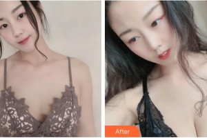 上海光博士醫(yī)療美容門(mén)診部阮雅君整形價(jià)格表附自體脂肪隆胸案例展示