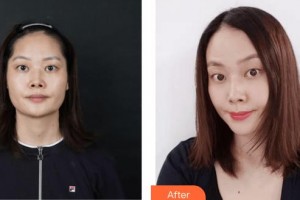 上?？祳W醫(yī)療美容醫(yī)院胡康容整形價格表附光子嫩膚案例展示