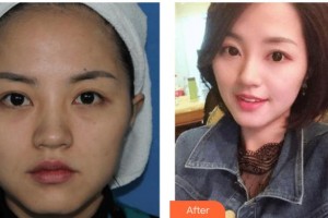 上海光博士醫(yī)療美容門診部錢雪華整形價格表附光子嫩膚案例展示