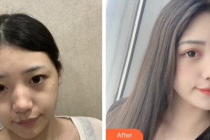 上海復(fù)旦大學(xué)附屬中山醫(yī)院整形外科施越冬整形價格表附激光祛斑案例展示