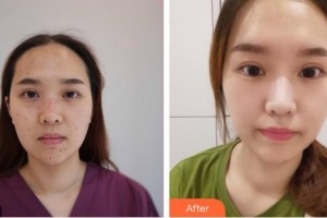 上海市皮膚病醫(yī)院醫(yī)療美容科章偉整形價格表附激光祛痣點(diǎn)痣案例展示