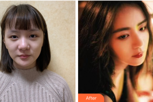 廣州市荔灣區(qū)人民醫(yī)院整形美容中心杜毅整形價(jià)格表附肋軟骨隆鼻案例展示