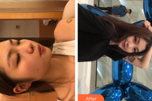 廣州市荔灣區(qū)人民醫(yī)院整形美容中心趙菲菲整形價(jià)格表附光子嫩膚案例展示