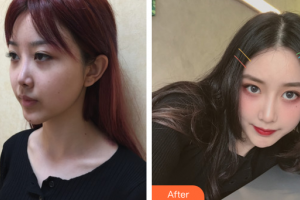 廣州番禺陽光整形美容醫(yī)院易東風(fēng)整形價(jià)格表附隆鼻案例展示