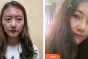 廣州美恩整形美容醫(yī)院周三民整形價(jià)格表附肋軟骨隆鼻案例展示