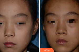 廣州美恩整形美容醫(yī)院朱思蓉整形價(jià)格表附激光點(diǎn)痣案例展示