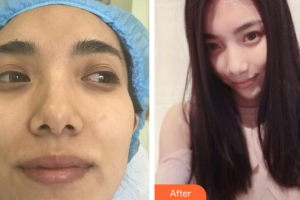 廣州美恩整形美容醫(yī)院王才仁整形價(jià)格表附小氣泡單次體驗(yàn)案例展示