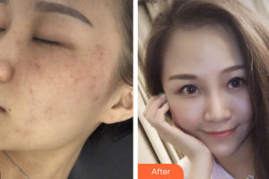 廣州曙光醫(yī)學(xué)美容醫(yī)院陳光平整形價(jià)格表附祛斑祛痣案例展示