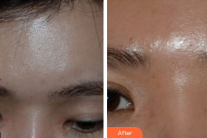 廣州美恩整形美容醫(yī)院汪晴整形價(jià)格表附激光美膚洗眉案例展示