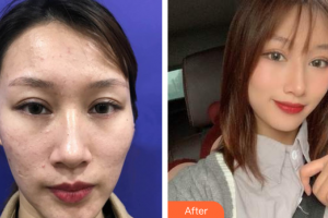 廣州美恩整形美容醫(yī)院王露整形價(jià)格表附皮膚管理案例展示