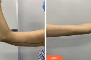 廣州美涵醫(yī)療整形美容醫(yī)院蘇錦和整形價(jià)格表附吸脂案例展示