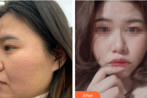 廣州美恩整形美容醫(yī)院賀芳秀整形價(jià)格表附祛痘坑案例展示