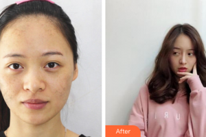 廣州解放軍第四五八醫(yī)院激光整形美容中心陳柯整形價(jià)格表附激光美膚激光祛斑案例展示