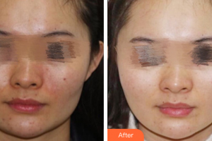 廣州解放軍第四五八醫(yī)院激光整形美容中心張陽(yáng)整形價(jià)格表附美白亮膚祛痘印案例展示