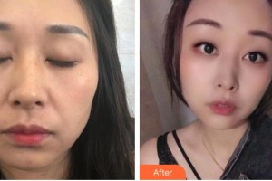 上海WA臻景醫(yī)療美容門診部Linde整形價格表附面部自體脂肪填充案例展示