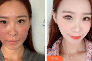 上海瑞東醫(yī)院美容皮膚科周采青整形價格表附皮膚管理案例展示