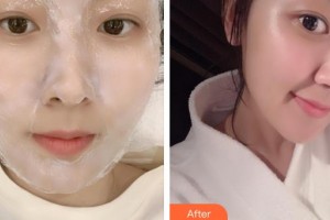 上海紐菲思醫(yī)療美容門診部孟玲玲整形價格表附點(diǎn)陣激光案例展示