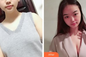 上海美立方整形醫(yī)院楊曉松整形價格表附濃縮豐胸真實(shí)案例展示