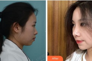 上海宸妃醫(yī)學(xué)美容醫(yī)院王雷整形價格表附打造精致自然翹鼻案例展示