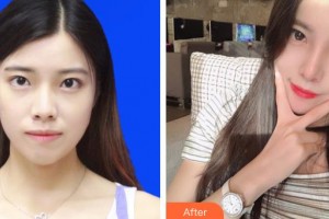 上海伊萊美醫(yī)療美容醫(yī)院邱文苑整形價格表附肋軟骨隆鼻案例展示