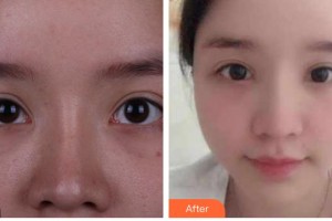 上海華美醫(yī)療美容醫(yī)院楊亞益整形價格表附眼部整形案例展示