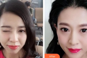 上海達(dá)醫(yī)院醫(yī)療美容科馬秀偉整形價格表附發(fā)際線種植案例展示