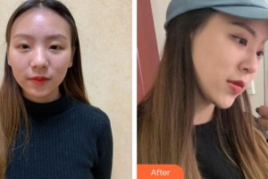 上海美爾雅醫(yī)療美容醫(yī)院趙祐晟整形價格表附自體肋軟骨隆鼻案例展示