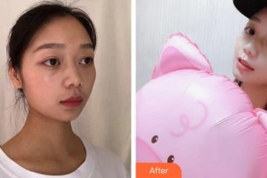 上海亞柏醫(yī)療美容診所曲妙軒整形價格表附全切雙眼皮+外眼角案例展示