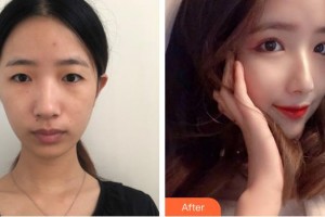 上海亞柏醫(yī)療美容診所徐文龍整形價格表附美鼻部手術(shù)案例展示