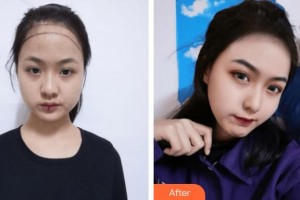 上海首爾麗格醫(yī)療美容醫(yī)院洪榕宅整形價格表附美女發(fā)際線種植案例展示
