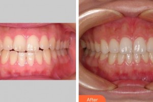 上海伊萊美醫(yī)療美容醫(yī)院李慶云整形價格表附隱形托槽矯正案例展示