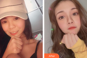 廣州解放軍第四五八醫(yī)院激光整形美容中心崔鳳祥整形價(jià)格表附玻尿酸導(dǎo)入案例展示