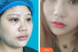 上海明慨醫(yī)療美容門診部朱士品整形價格表附面部吸脂案例展示