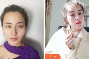 上海明慨醫(yī)療美容門診部王胡飛整形價格表附顴骨顴弓整形術(shù)案例展示