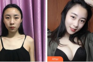 上海明慨醫(yī)療美容門診部慎孔宇整形價格表附假體隆胸案例展示