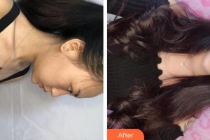 上海明慨醫(yī)療美容門診部陳建君整形價格表附果酸煥膚案例展示