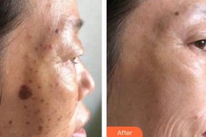 上海明慨醫(yī)療美容門診部田甜整形價格表附激光美膚激光祛斑案例展示