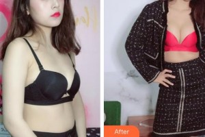 上海明慨醫(yī)療美容門診部王亮整形價格表附濃縮豐胸真實案例展示