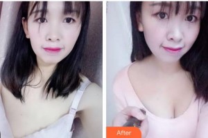 上海亞柏醫(yī)療美容診所童新輝整形價格表附濃縮豐胸真實案例展示