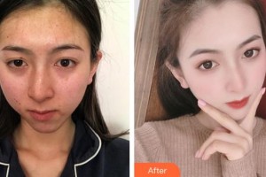 上海伊美爾港華醫(yī)療美容醫(yī)院劉坤整形價格表附鼻部手術(shù)案例展示