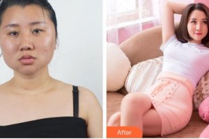 醫(yī)療美容門診部白承燦整形價格表附濃縮豐胸真實案例展示