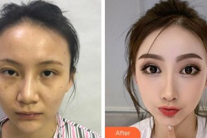 醫(yī)療美容門診部盧建整形價格表附隆鼻案例展示