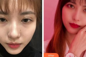 上海美侖醫(yī)療美容門診部胡曉龍整形價格表附超激光美膚嫩膚多方面部案例展示