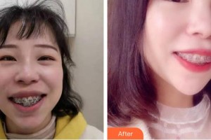 上海百達麗醫(yī)療美容醫(yī)院顧珍麗整形價格表附牙齒矯正案例展示