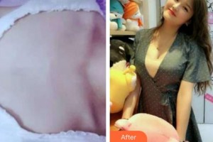 上海時光整形外科醫(yī)院邱曉玲整形價格表附隆胸案例展示